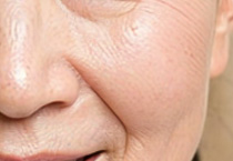 丰面颊与法令纹的关联疑问