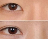 上睑下垂自救指南！3大矫正术式全解析，选对方法才能“睁眼有神”