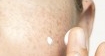 美白注射：一场“以白为美”的冒险？揭开未获批疗法的真相与替代方案