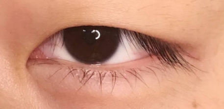 眼型矫正术后恢复大揭秘：多久才能重焕灵动双眸？