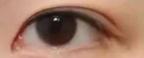 内双星人必看！埋线法VS三点定位法，哪款双眼皮手术能让你“睛”彩蜕变？
