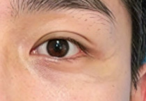 男生双眼皮手术：宽度与线条设计的差异