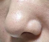 鼻综合术后多久能打微针？安全时间线+护理指南全解析