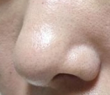 术后鼻孔不对称别慌！这些方法助你恢复完美鼻型