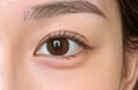 秋季进行双眼皮和提眉手术的效果对比如何-54144