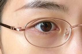 秋季割双眼皮后如何避免切口渗血