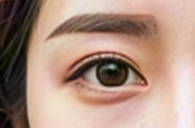 秋季割双眼皮后如何消肿