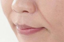 如何消除法令纹的几大攻略来啦！