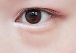 受到眼袋困扰的集美们该如何解决眼袋的困扰？