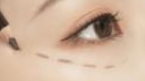 整形后避免做这些事 既能帮助手术恢复 还能延长维持时间