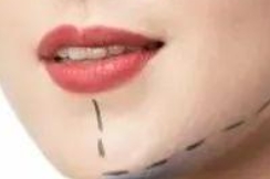 玻尿酸注射过多脸真的会僵吗？如果脸僵了怎么办？