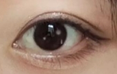 如何改善十分影响美观的上眼睑松弛!