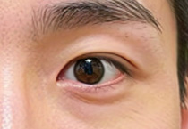 秋季整形热潮下的特殊疑问：男生割双眼皮的适宜性