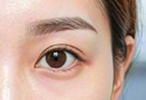季节与双眼皮手术：秋季与夏季效果大比拼