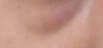 告别传统手术刀！2025年去眼袋黑科技：干细胞+3D打印重塑眼周年轻态-54413