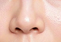 面部协调性考量:胶原蛋白隆鼻是否适合鼻基底填充?