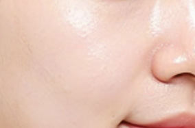 皮秒激光和光子嫩肤哪个适合军训后美白？-54540