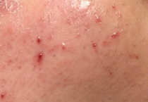 医美项目后爆痘,是正常“小插曲”还是危险信号