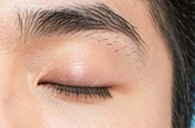 提肌过度导致睁眼凶狠如何修复