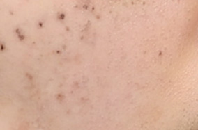 军训后黑色素沉积：超皮秒与普通激光的祛斑效果对比-54586