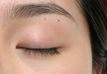 多次眼修复后，是否还有再修的可能？