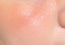 秋季医美后能否化妆?解锁不同项目术后安全化妆时间表