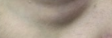 眼袋手术：真的能让你年轻10岁吗？揭秘术后效果真相-54807