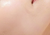 光子嫩肤与水光注射:能否携手共筑美肌