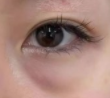 眼袋手术能改写人生剧本？科学真相与理性选择大揭秘！