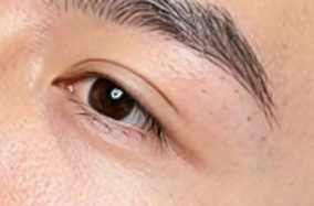 男性做双眼皮需要注意什么？-54803