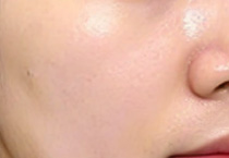 敏感肌双节能否做医美如何避免“烂脸”