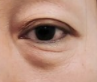 眼袋手术后多久能纹美瞳线？医生提醒：这个时间点很关键！
