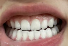 矫正牙齿后,你的笑容会“白”上加白吗?揭秘牙齿矫正与美白的真相