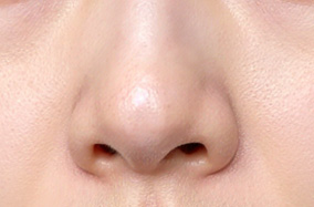 隆鼻假体需要定期换吗？-54902