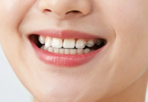 隐形矫正适合所有人吗?会不会导致“牙套脸”