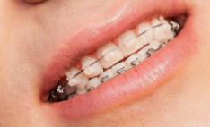 矫正期接吻指南:浪漫时刻如何避开“钢牙刺客”?