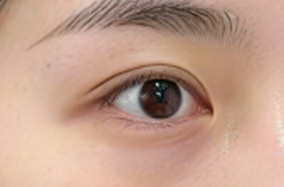 眼袋修复后下睑外翻如何处理?