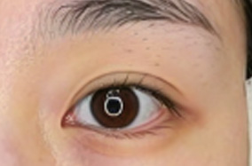 眼修复术后多久能化妆？