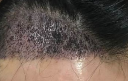 毛发种植：永久性效果背后的科学真相与养护秘诀