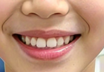 19岁开启牙齿矫正之旅：矫正费用究竟要花多少