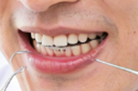 牙齿正畸大揭秘:整个过程究竟要耗费多长时间