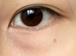 眼袋手术成功就万事大吉?防复发秘籍让你美丽更持久!-55241