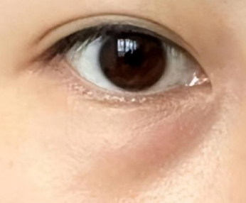 眼袋手术后复查有多重要?这些时间节点千万别错过!