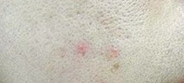 痘痘肌刷酸指南:低浓度酸类是救星还是雷区?