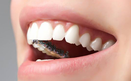 牙齿矫正必看!三大关键注意事项,助你轻松拥有完美笑容