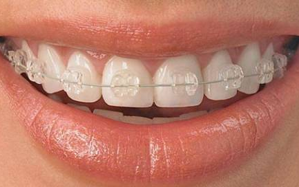 牙齿矫正期想吹乐器?这些要点让你吹奏、矫正两不误!