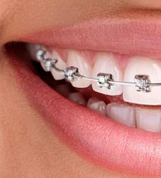 牙齿矫正会让你“口齿不清”?真相在这里!