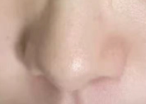 鼻头矫正术前必看！这些检查一个都不能少，安全变美从细节开始