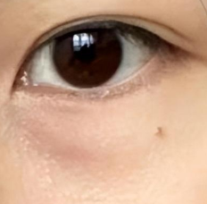 超声波去眼袋全解析:原理揭秘与适用人群指南