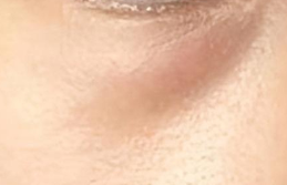 溶脂注射去眼袋真相揭秘:安全风险与选择指南